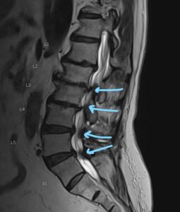 Spondylosis – Ashwin Kamath, MD