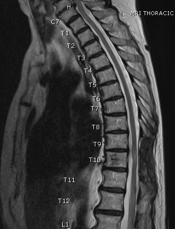 Spinal Tumor – Ashwin Kamath, MD